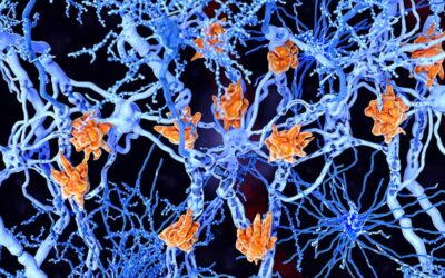 How a hyperactive cell in the brain might trigger Alzheimer’s disease