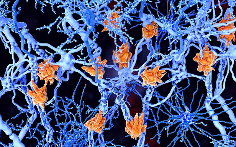 How a hyperactive cell in the brain might trigger Alzheimer’s disease